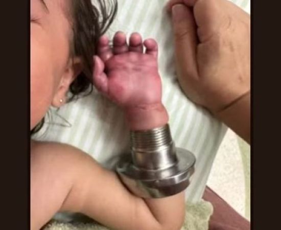 Bebê sofre acidente grave após braço ser sugado por tubulação de piscina em SP.